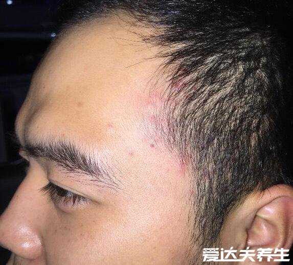 脸部长痘对应五脏的图,可不是内分泌失调那么简单