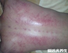 刮痧的好处和坏处,能祛除湿气排出毒素但