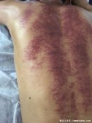 湿气重刮痧图片，颜色黑紫是湿气重（可