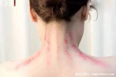 这8种人千万不能刮痧,轻者不适重则危及生