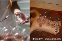 正确的拔罐图片大全，位置不同功能不同
