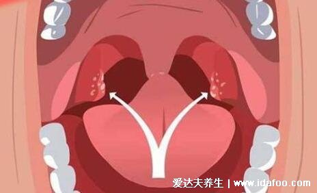 扁桃体发炎最怕三种水果,暂时不要吃榴莲/荔枝/芒果当心加剧