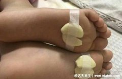 治咳嗽10个小偏方，大蒜治咳嗽一夜见效(敷