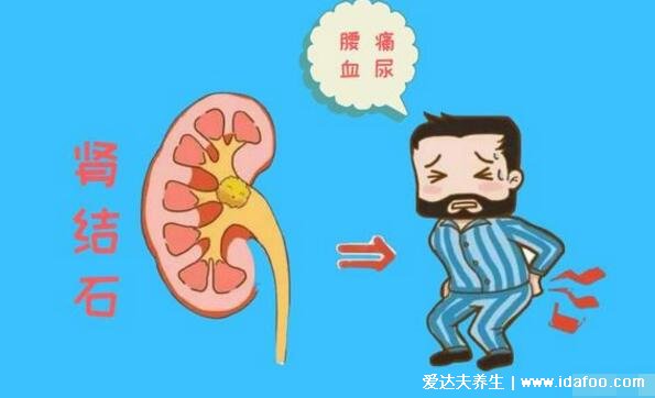 坚持肾结石五吃三不吃,注意睡前喝牛奶会加重结石