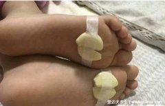 民间治咳嗽的52个偏方，大蒜切片敷脚心一夜