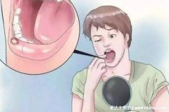 口腔溃疡吃什么好的快,5个一夜治好口腔溃